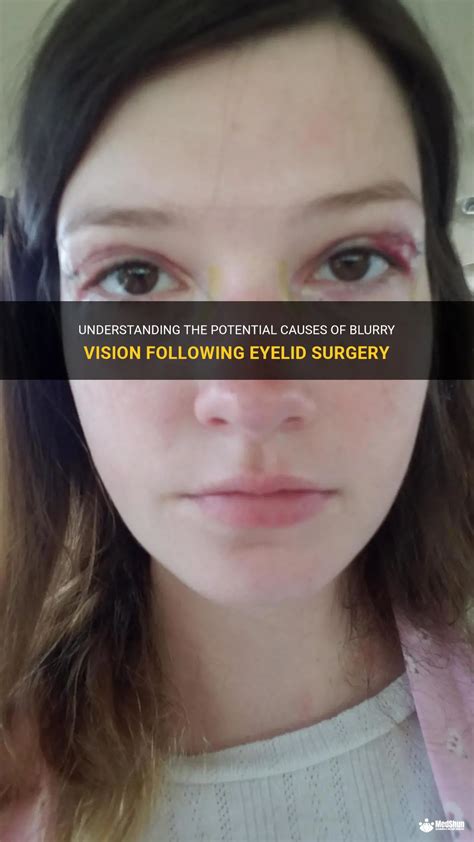 Understanding The Potential Causes Of Blurry Vision Following Eyelid Surgery Medshun