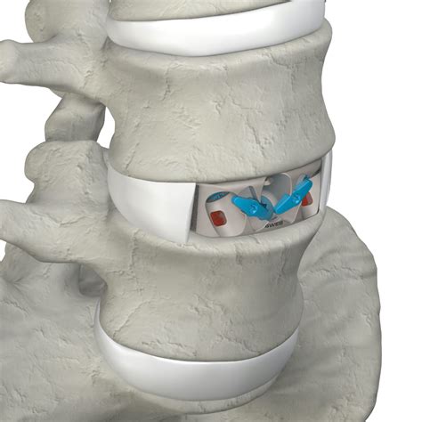 Stand Alone Anterior Spine Truss System 4WEB Medical