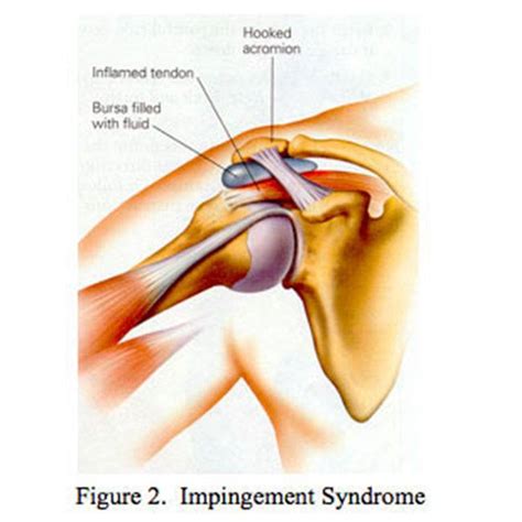 Shoulder Impingement Syndrome Los Angeles Shoulder Pain Beverly Hills