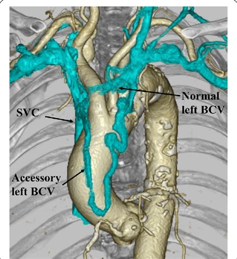 The 3D-reconstructed image of the double left brachiocephalic vein.... | Download Scientific Diagram