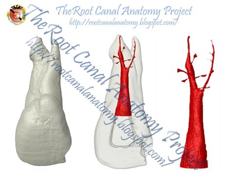 The Root Canal Anatomy Project: Two-Rooted Maxillary Central Incisor