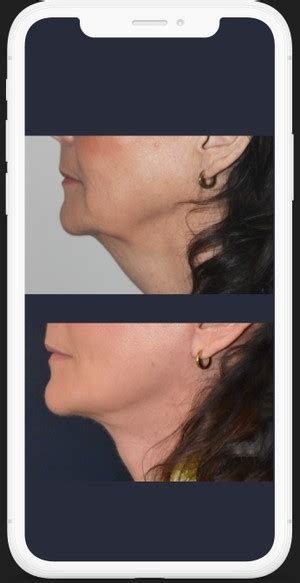 Deep Plane Facelift Amsterdam Netherlands Face Institute