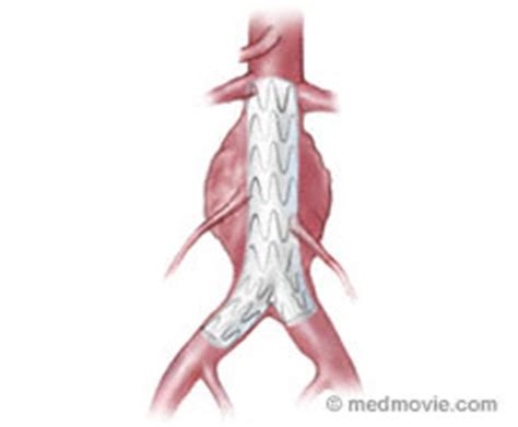 Abdominal Aortic Stent