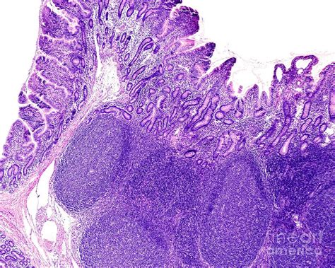 Intestinal Peyer S Patches Photograph By Jose Calvo Science Photo