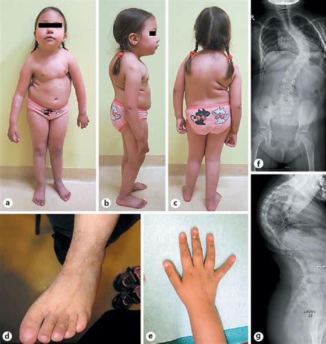 A New Case Of A Rare Combination Of Temple Syndrome And Mosaic Trisomy