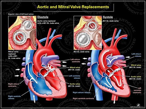 Aortic and Mitral Valve Replacements