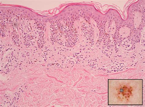 Dysplastic Pointillist Nevus Dermatology Jama Dermatology Jama