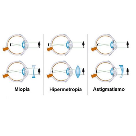 Lentes De Contato Para Miopia E Astigmatismo