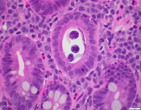 Pathology Outlines Infectious Disorders General