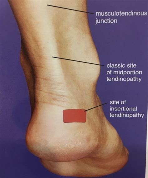 Achilles Tendinopathy Casey Allied Health