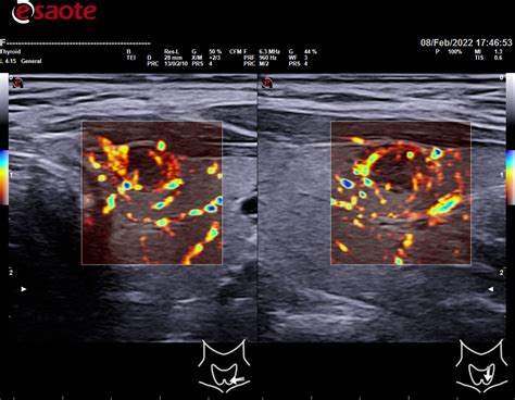 Rfa Radiofrequency Ablation Of Micropapillary Thyroid Cancer Tnt