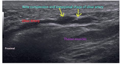 Ultrasound-Guided Ulnar Nerve Block at the Wrist | Anesthesia Key