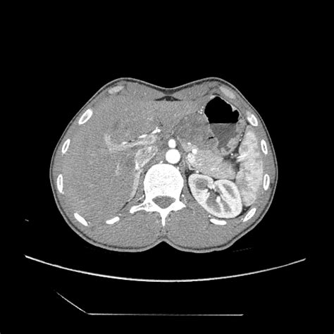 Gastrointestinal Stromal Tumor Gist Image