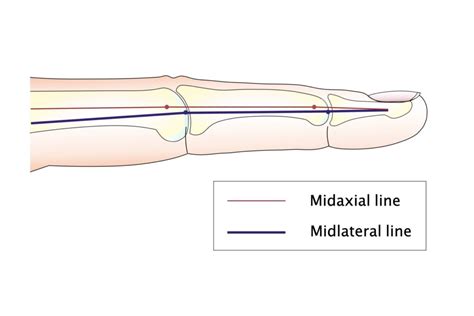 【Free illustrations】Bruner's incision, Midlateral incision, Midaxial ...