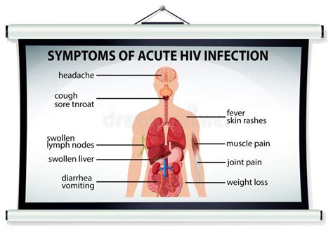 Mapa Pokazuje Objawy Ostry Zakażenie Wirusem Hiv Ilustracja Wektor