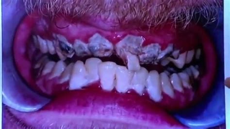 Mostró Sus Dientes Luego De 20 Años Sin Lavárselos Infobae