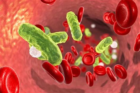 What Is Septicemia Causes Symptoms And Treatment