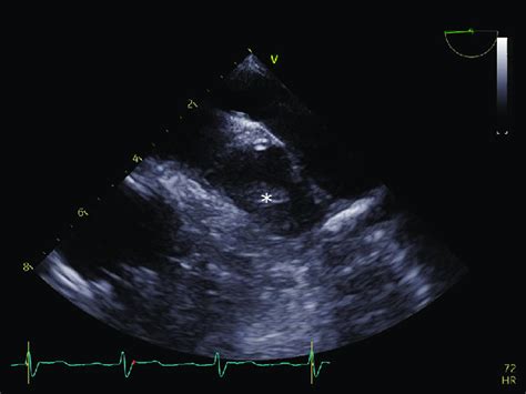 Transesophageal Echocardiography Tee Image Recorded Before The Download Scientific Diagram