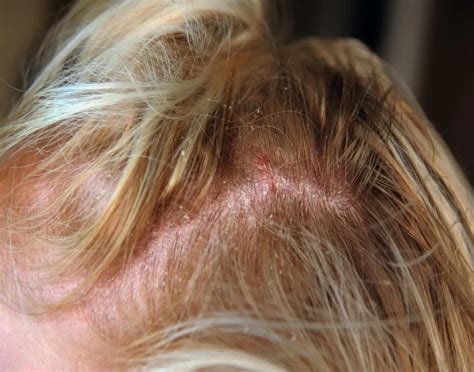 Scalp Redness Causes Dos And Donts Hands In