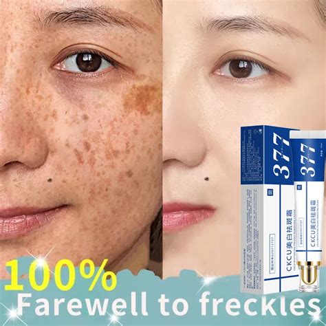 Effective Whitening Freckle Cream Remove Melasma Acne Spot Pigment