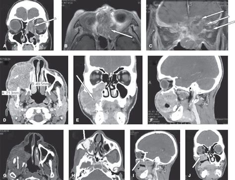 Cancer Of The Nasal Cavity And Paranasal Sinuses Oncohema Key