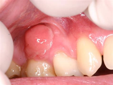 Fibroma Cemento Ossificante Periférico