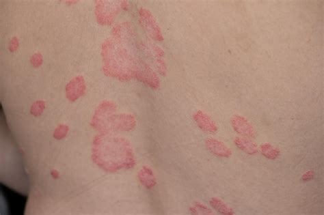 Las Manchas Cut Neas De La Psoriasis Vulgar Son T Picamente Rojas Con