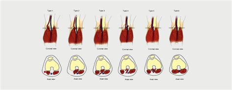 POPLITEAL ARTERY ENTRAPMENT SYNDROME (PAES) - MOTUS Physical Therapy