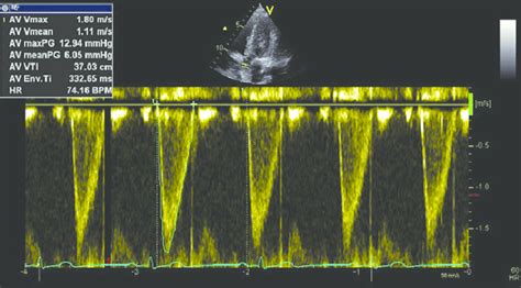 Measurements Of Left Ventricular Outflow Tract Velocity Time Integral Download Scientific