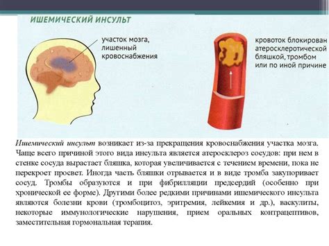 Реабилитация после инсульта - презентация онлайн