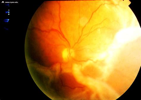 Rhegmatogenous Retinal Detachment Nyee