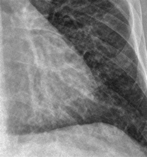 Interstitial Vs Alveolar Lung Patterns WikiRadiography