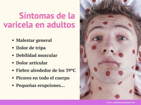 Varicela en Adultos Fotos Síntomas y Tratamiento