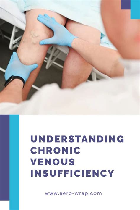 Venous insufficiency treatment – Artofit