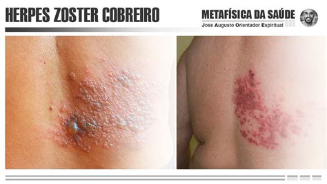 Metaf Sica Da Sa De O Que Provoca A Herpes Zoster Conhecido