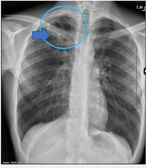 Chest X-ray showing findings of poorly defined infiltrates with a... | Download Scientific Diagram