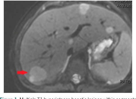 Figure From A Case Of A Beta Catenin Activated Hepatic Adenoma In A