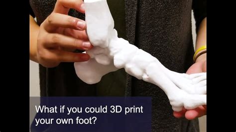 3d Printed Bones Give Patients A Look Inside Their Own Bodies Youtube