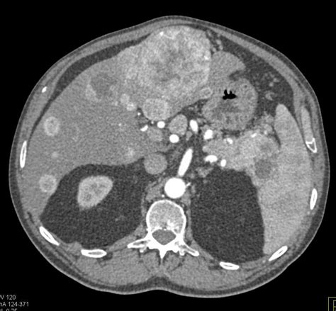 Pancreatic Neuroendocrine Tumor Pnet Tail Of The Pancreas With Liver