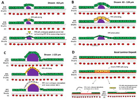 Schematic Representation Of Retinal Pigment Epithelium Rpe Loss And