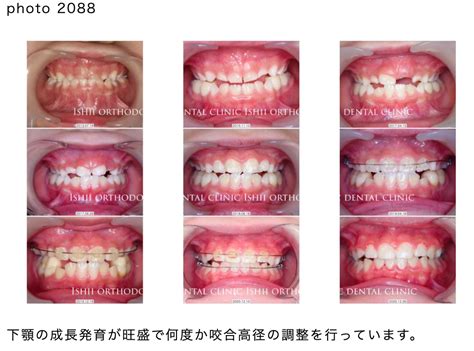 小児矯正における反対咬合の1期治療について【album 356】 石井ちゃんのひとりごと