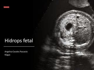 Hidrops Fetal Pptx