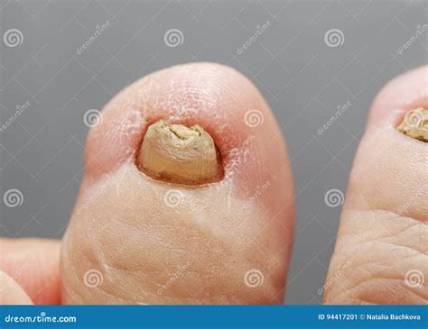 Toenails Affected By Fungal Infection Onychomycosis Royalty Free Stock