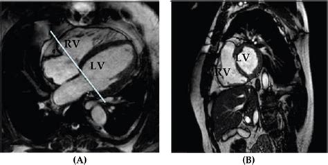 Cardiac MRI In Diastolic Phase A Long Axis Slice B Short Axis