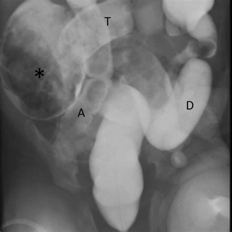 Image From A Water Soluble Contrast Enema There Is A Filling Of A