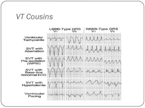 What Are The Different Types Of Ventricular Tachycardia Bdiv