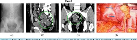 Pdf Three Inverted Meckels Diverticula Cases With Ileus Diagnosed