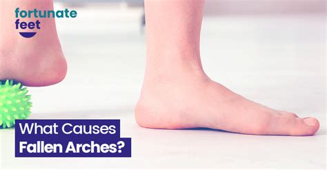 What Causes Fallen Arches Fortunate Feet