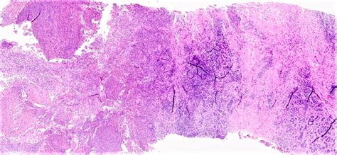 Mastitis Vs Abscess