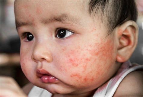 How long does baby acne last? - AD Biztech